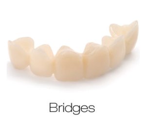 Dental Bridges