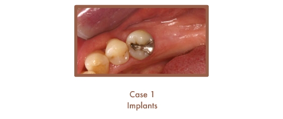 Case 1 Implants