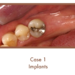 Case 1 Implants