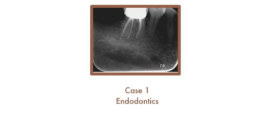 Case 1 Endodontics