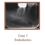 Case 1 Endodontics