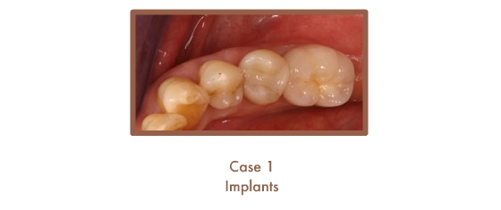 Case 1 Implants