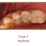 Case 1 Implants