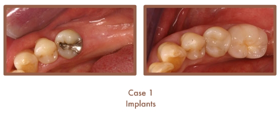 Case 1 Dental Teeth Implants