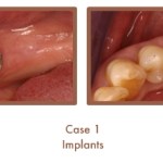 Case 1 Dental Teeth Implants