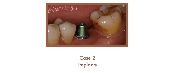 Case 2 Dental Teeth Implants