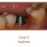 Case 2 Dental Teeth Implants