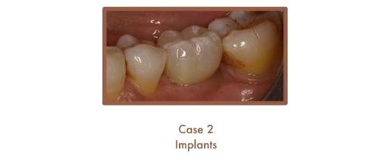 Case 2 Dental Teeth Implants