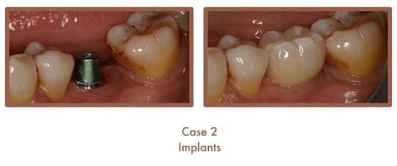 Case 2 Dental Teeth Implants
