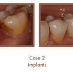 Case 2 Dental Teeth Implants