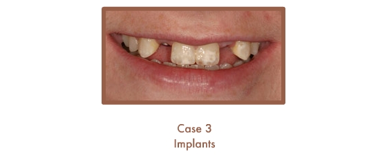 case 3 Dental Teeth Implants