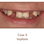 case 3 Dental Teeth Implants