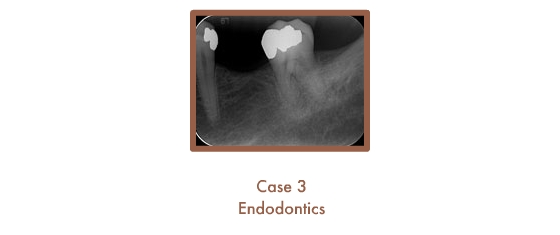 Case 3 Endodontics