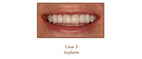Case 3 Dental Teeth Implants