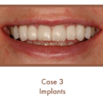 Case 3 Dental Teeth Implants