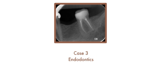 Case 3 cont. Endodontics