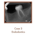 Case 3 cont. Endodontics