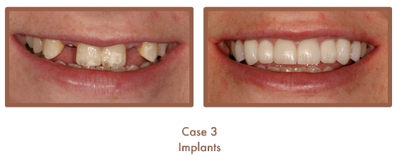 Case 3 Dental Teeth Implants