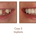 Case 3 Dental Teeth Implants