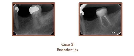 Case 3 cont. Endodontics