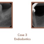 Case 3 cont. Endodontics