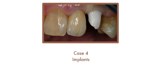 Case 4 Dental Teeth Implants