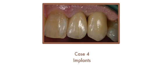 Case 4 Dental Teeth Implants