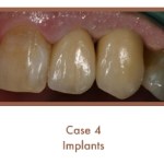 Case 4 Dental Teeth Implants