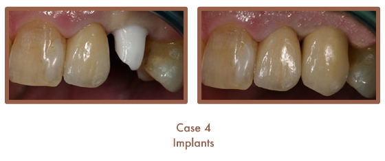 Case 4 Dental Teeth Implants