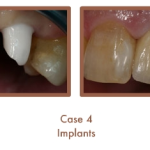 Case 4 Dental Teeth Implants