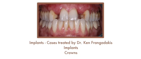 Dental Teeth Implants