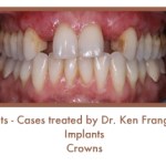 Dental Teeth Implants