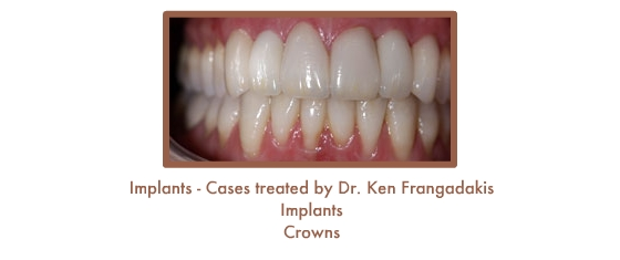 Dental Teeth Implants