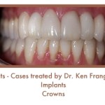 Dental Teeth Implants