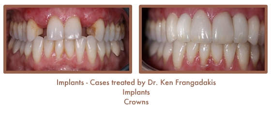 Dental Teeth Implants
