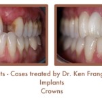Dental Teeth Implants